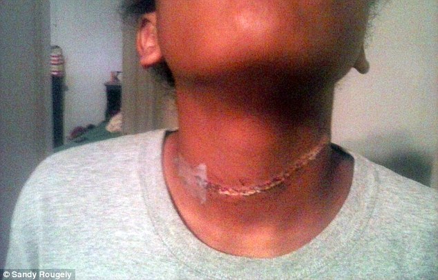 Rope Burn on Neck – Photo by Daily Mail (Courtesy of Google)
